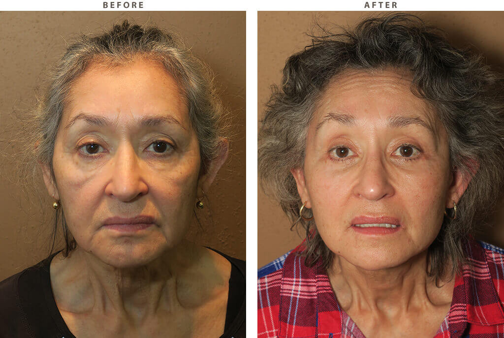 Complex Facial Rejuvenation Chicago - Before & After Pictures - Dr Gregory Turowski