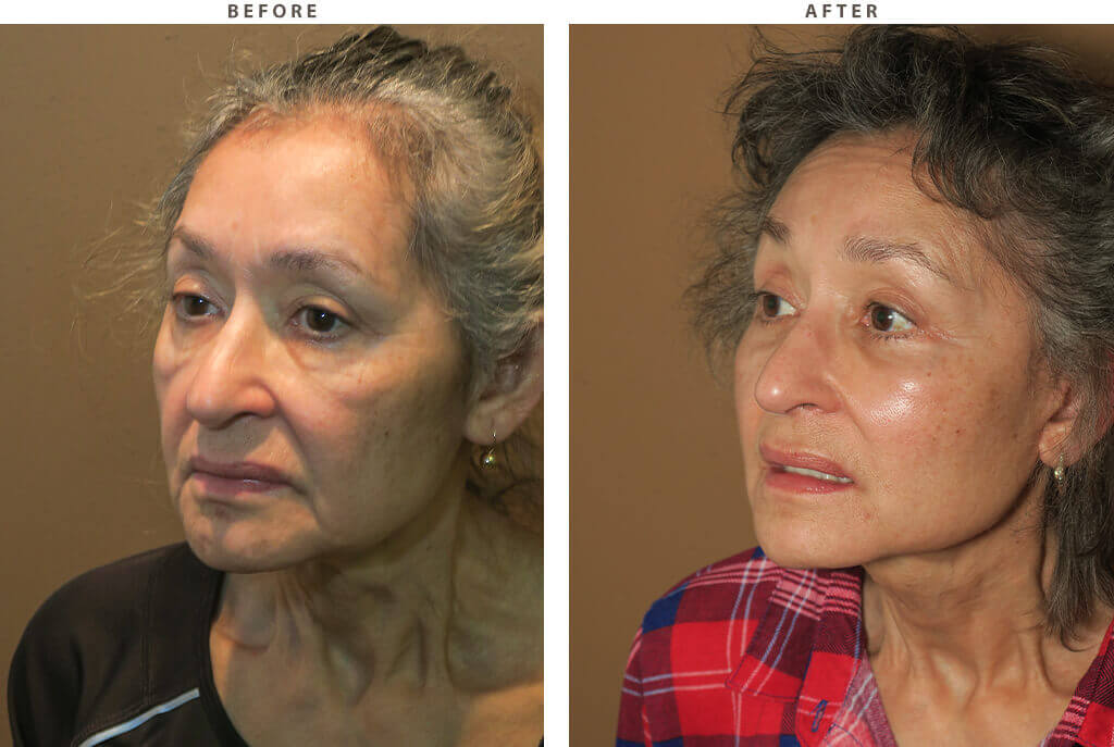 Complex Facial Rejuvenation Chicago - Before & After Pictures - Dr Gregory Turowski