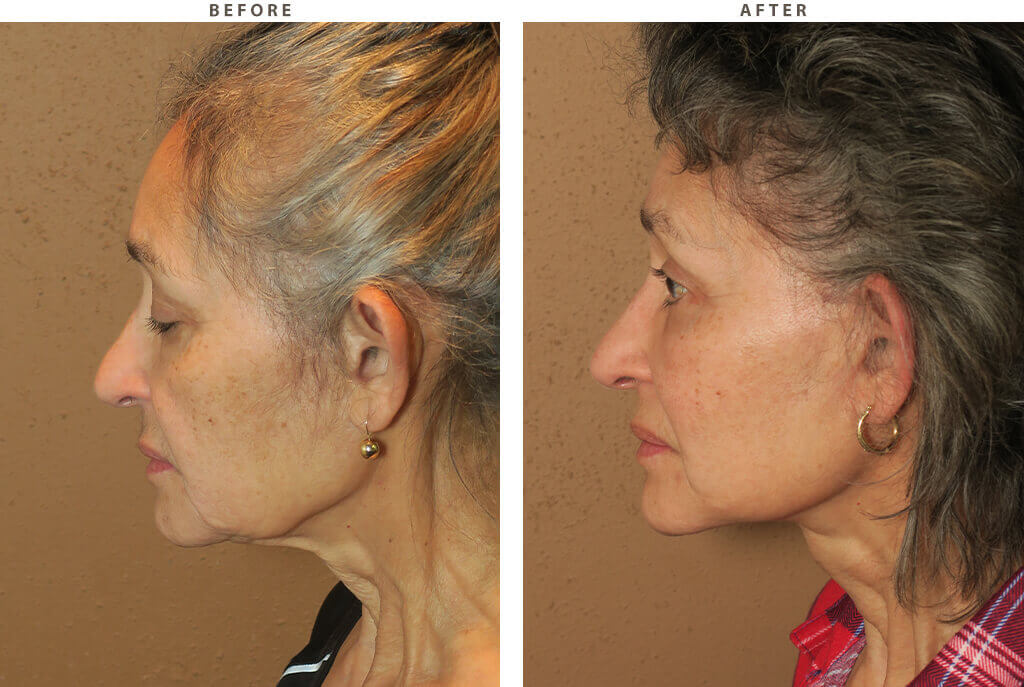 Complex Facial Rejuvenation Chicago - Before & After Pictures - Dr Gregory Turowski