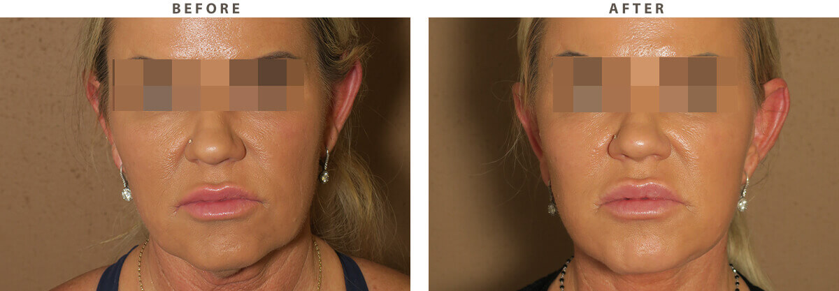 Facelift Chicago - Before & After Pictures - Dr Gregory Turowski