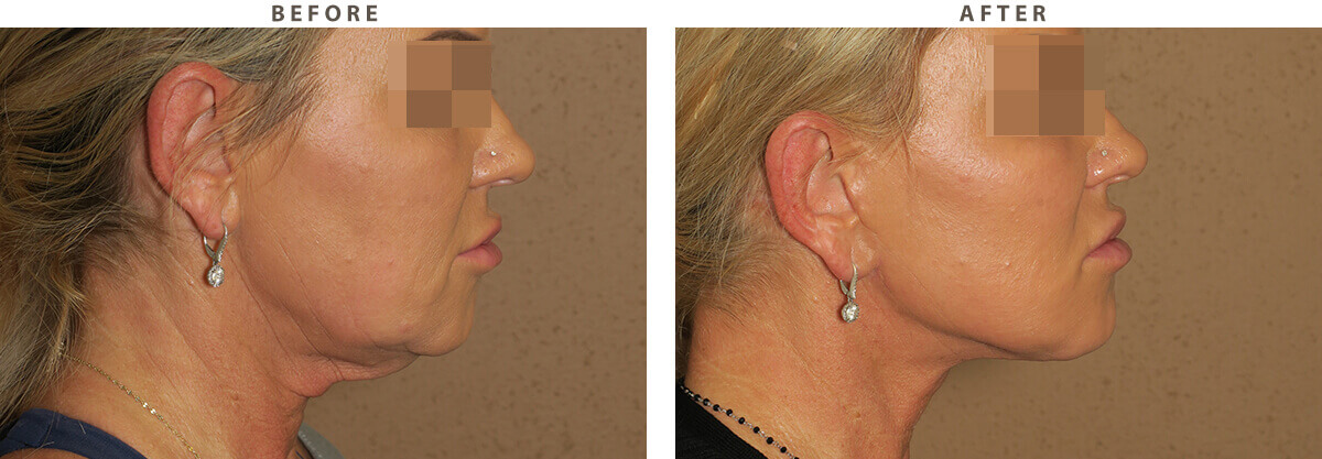 Facelift Chicago - Before & After Pictures - Dr Gregory Turowski