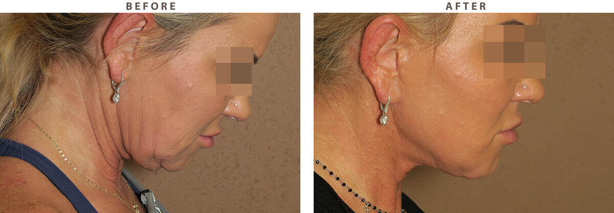 Facelift Chicago - Before & After Pictures - Dr Gregory Turowski