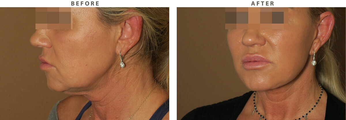 Facelift Chicago - Before & After Pictures - Dr Gregory Turowski