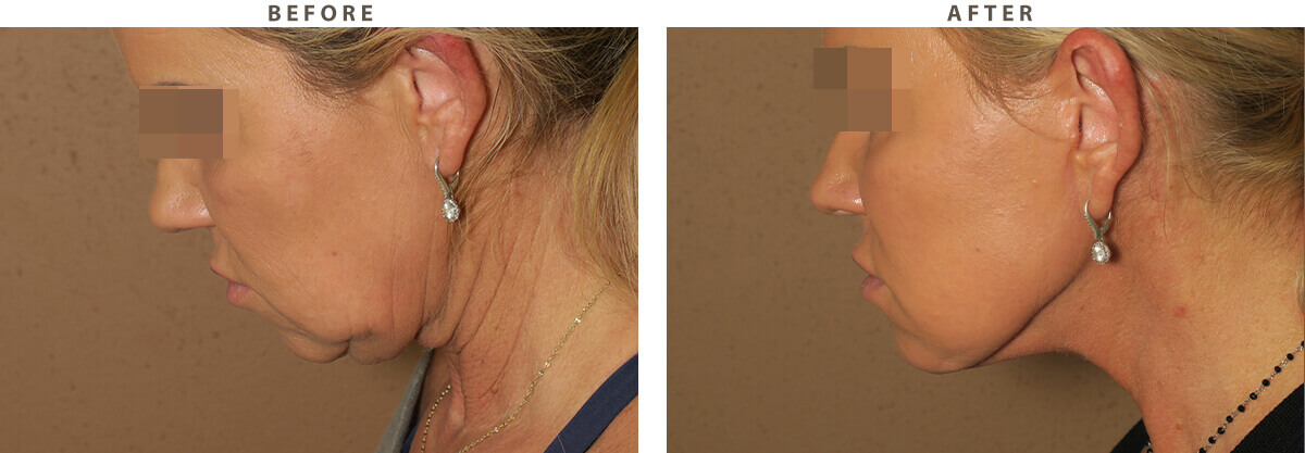 Facelift Chicago - Before & After Pictures - Dr Gregory Turowski