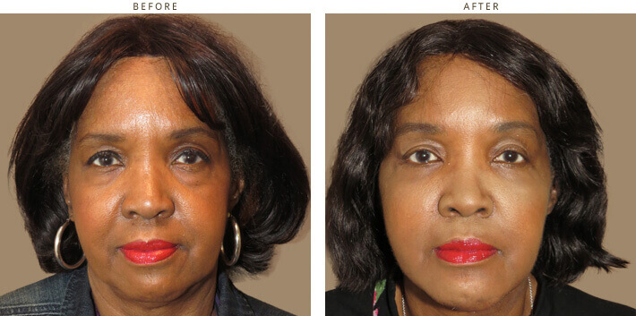 Complex Facial Rejuvenation Chicago - Before & After Pictures - Dr Gregory Turowski