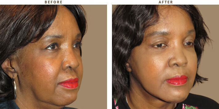 Complex Facial Rejuvenation Chicago - Before & After Pictures - Dr Gregory Turowski