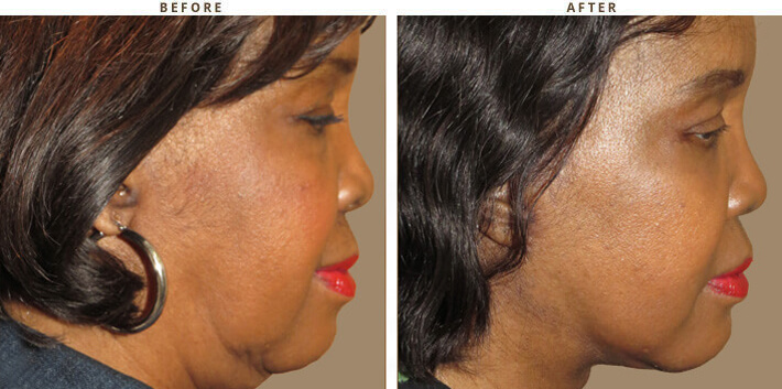 Complex Facial Rejuvenation Chicago - Before & After Pictures - Dr Gregory Turowski