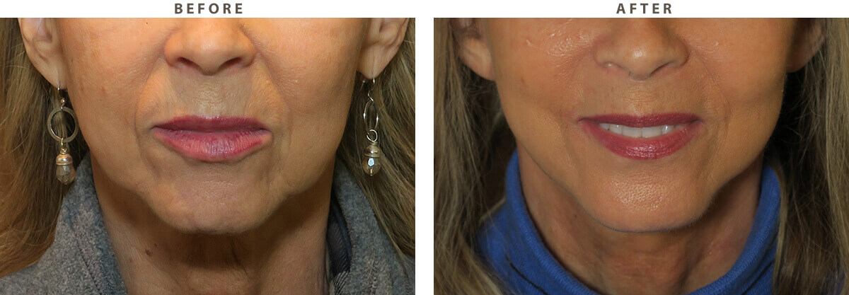 Facelift Chicago - Before & After Pictures - Dr Gregory Turowski