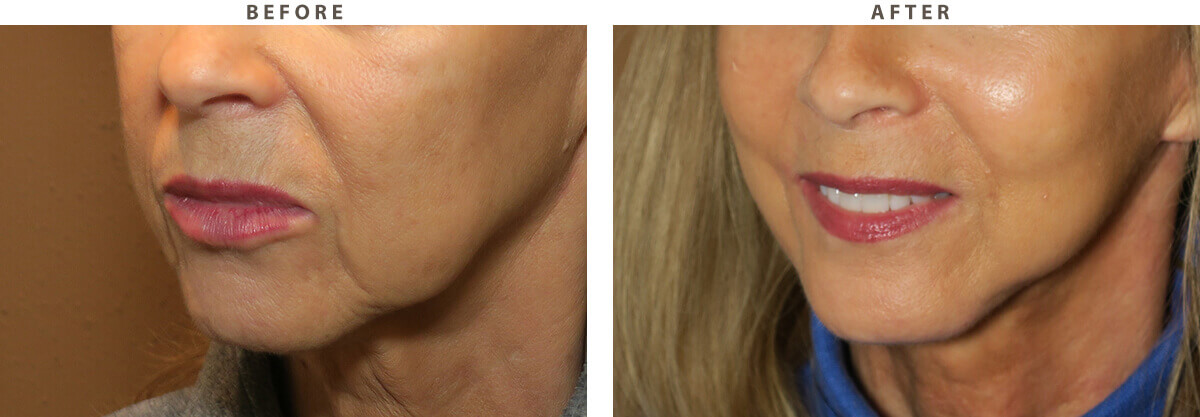 Facelift Chicago - Before & After Pictures - Dr Gregory Turowski