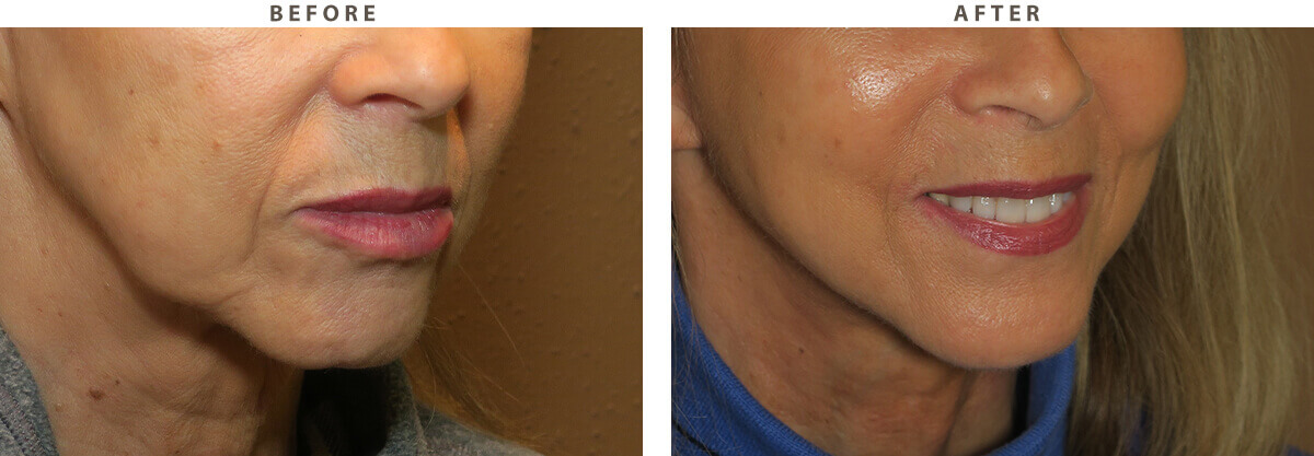 Facelift Chicago - Before & After Pictures - Dr Gregory Turowski