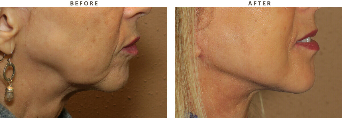 Facelift Chicago - Before & After Pictures - Dr Gregory Turowski