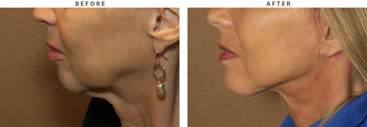 Facelift Chicago - Before & After Pictures - Dr Gregory Turowski