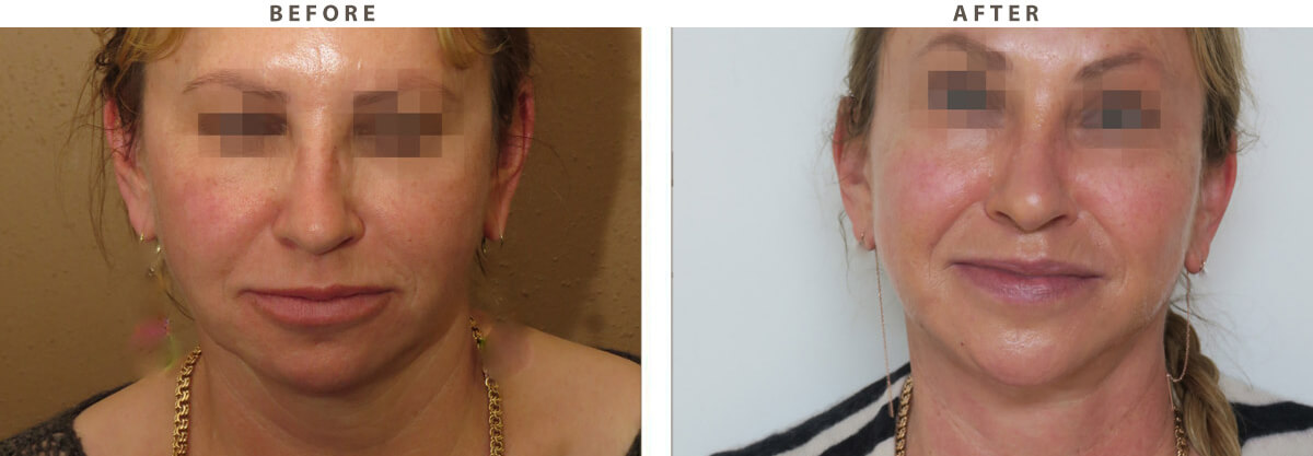 Facelift Chicago - Before & After Pictures - Dr Gregory Turowski