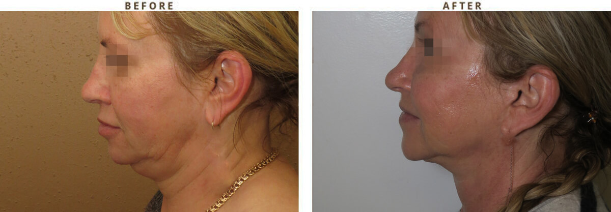 Facelift Chicago - Before & After Pictures - Dr Gregory Turowski