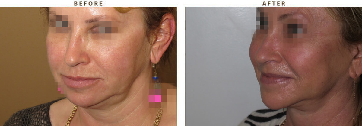 Facelift Chicago - Before & After Pictures - Dr Gregory Turowski