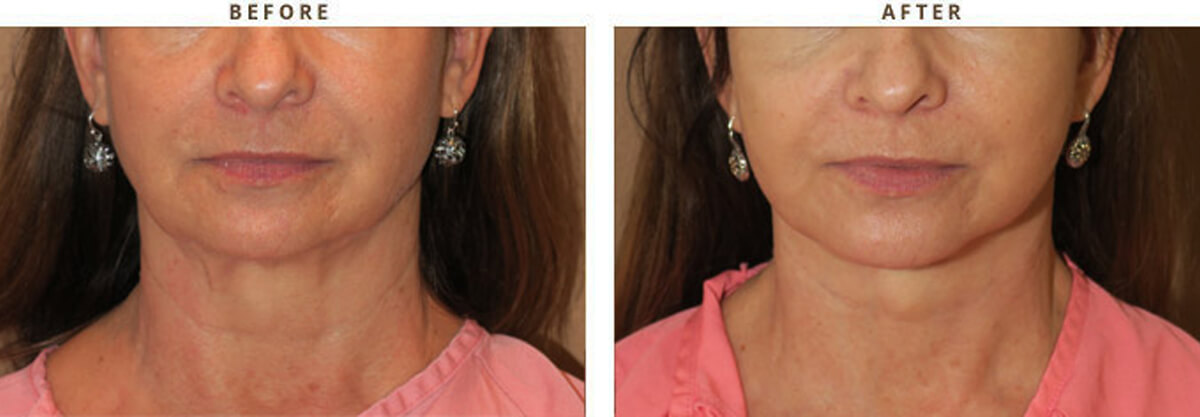 Facelift Chicago - Before & After Pictures - Dr Gregory Turowski