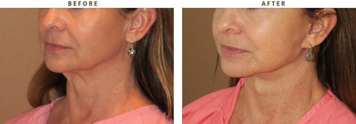 Facelift Chicago - Before & After Pictures - Dr Gregory Turowski