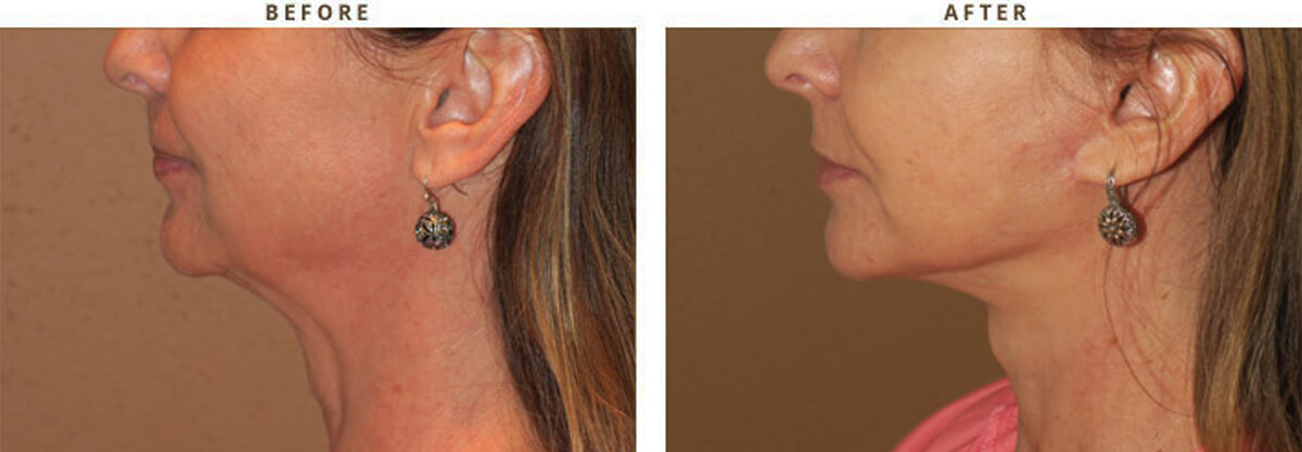 Facelift Chicago - Before & After Pictures - Dr Gregory Turowski