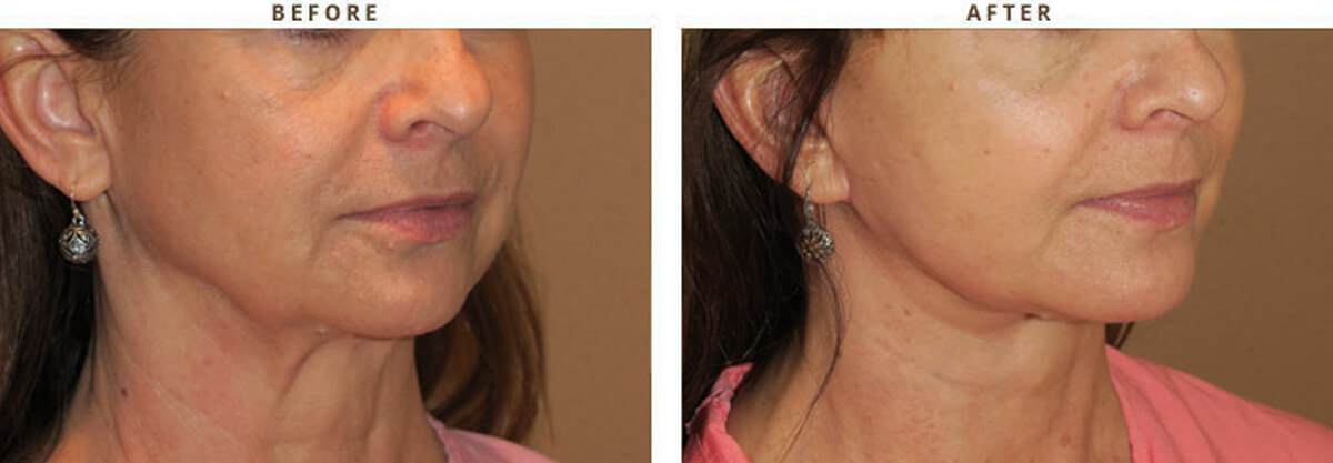 Facelift Chicago - Before & After Pictures - Dr Gregory Turowski