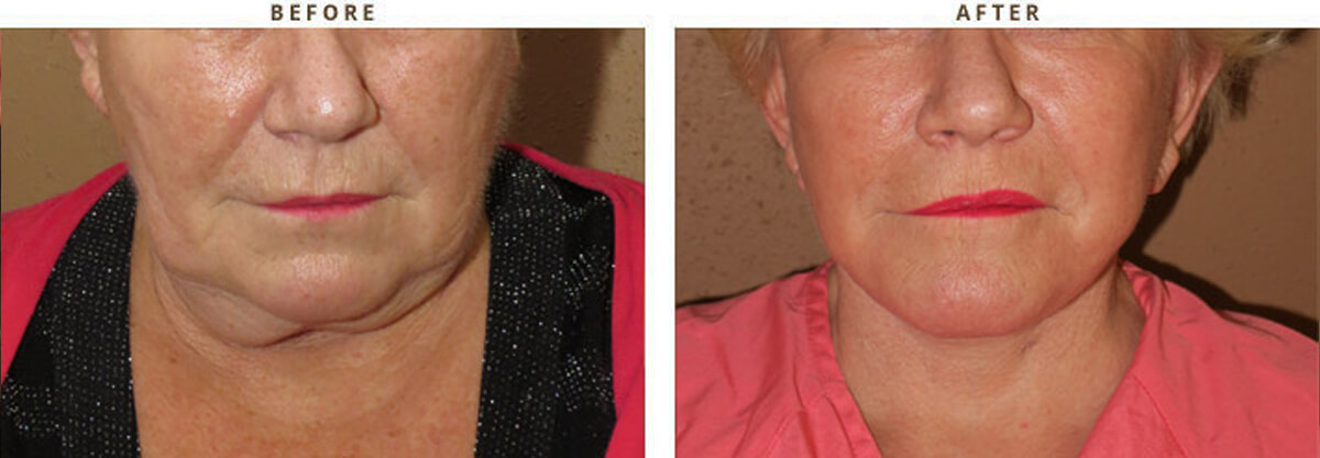 Facelift Chicago - Before & After Pictures - Dr Gregory Turowski