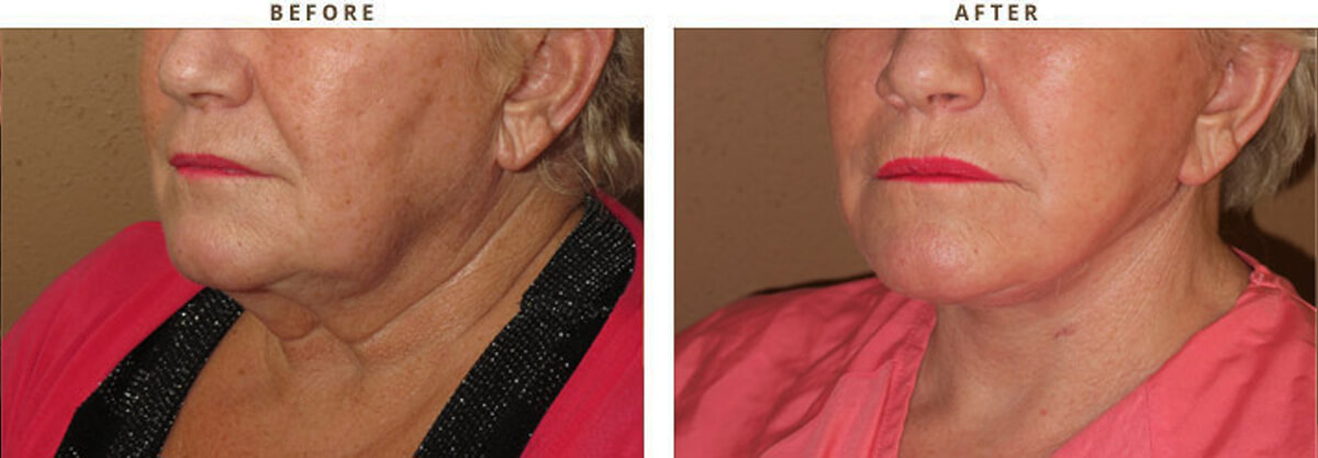 Facelift Chicago - Before & After Pictures - Dr Gregory Turowski