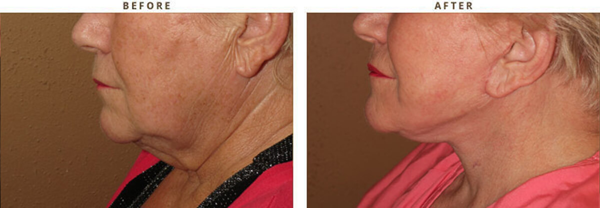 Facelift Chicago - Before & After Pictures - Dr Gregory Turowski