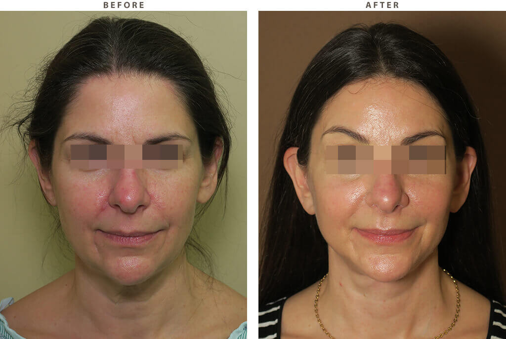 Complex Facial Rejuvenation Chicago - Before & After Pictures - Dr Gregory Turowski