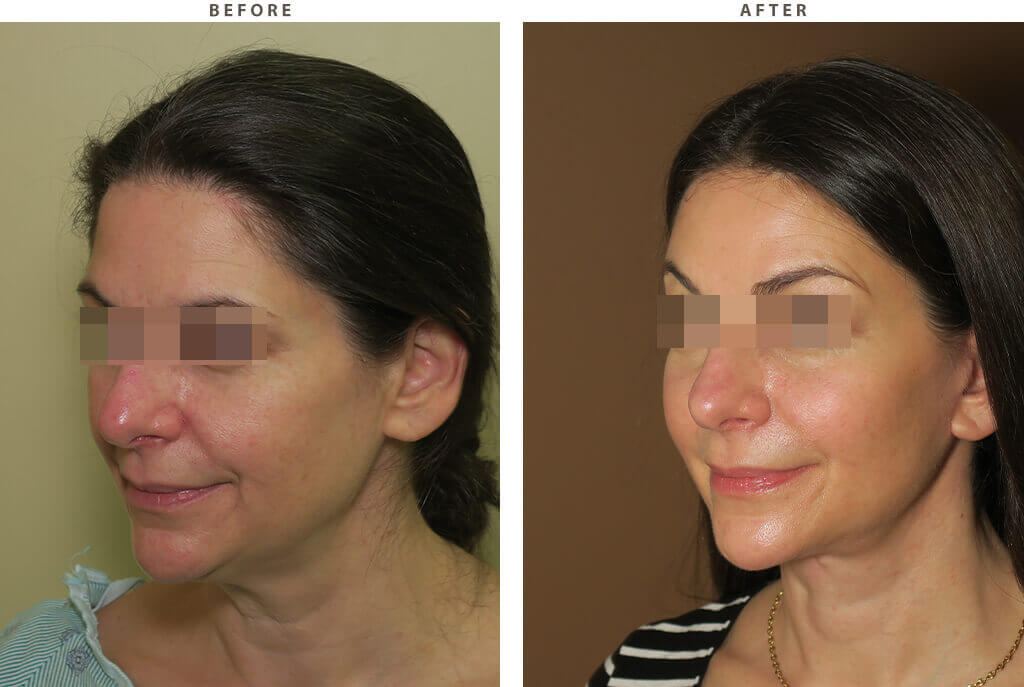 Complex Facial Rejuvenation Chicago - Before & After Pictures - Dr Gregory Turowski