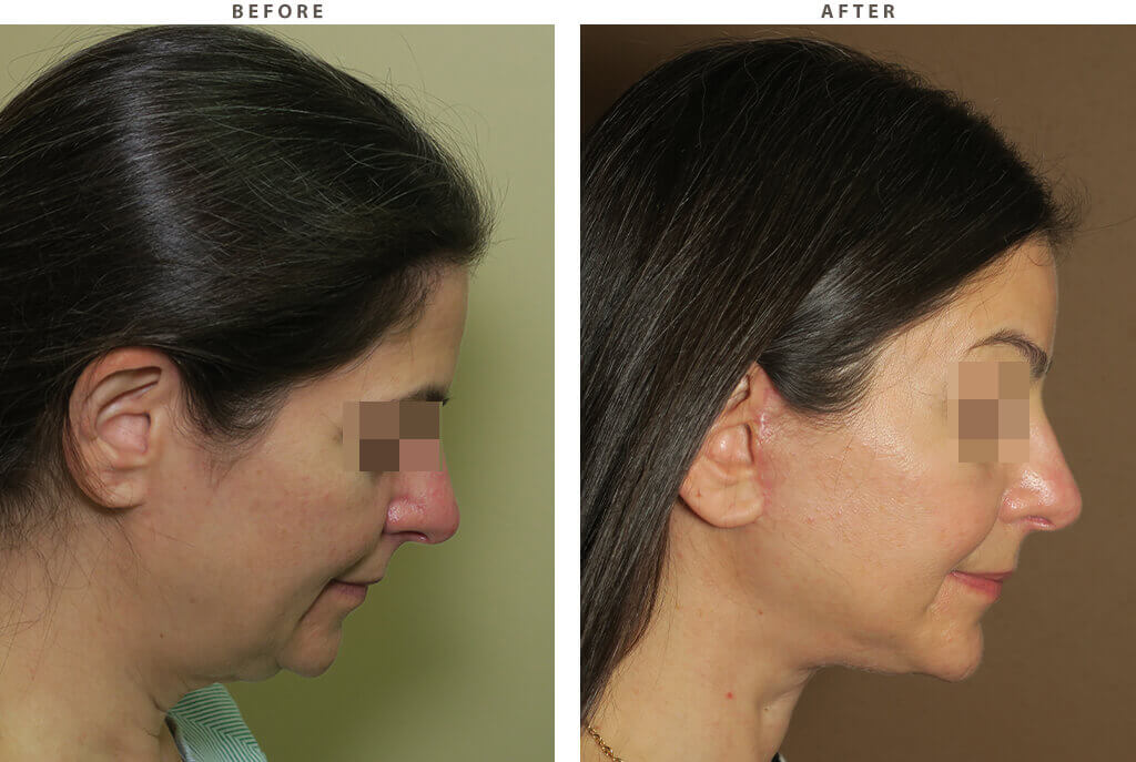 Complex Facial Rejuvenation Chicago - Before & After Pictures - Dr Gregory Turowski