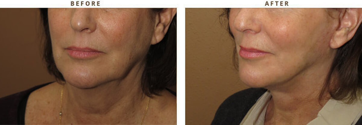 Facelift Chicago - Before & After Pictures - Dr Gregory Turowski