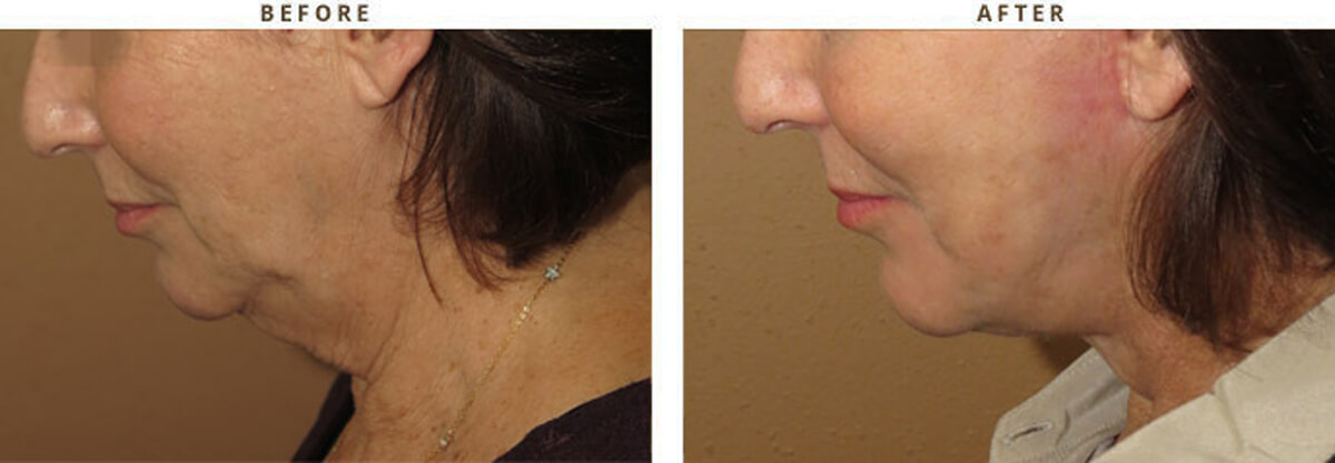 Facelift Chicago - Before & After Pictures - Dr Gregory Turowski