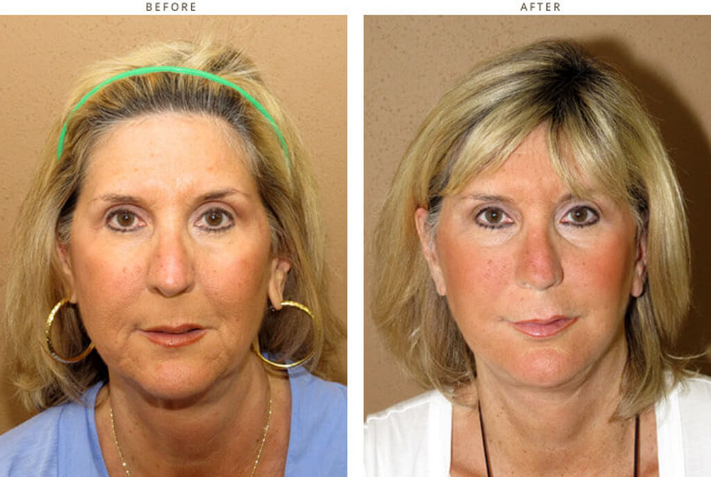 Complex Facial Rejuvenation Chicago - Before & After Pictures - Dr Gregory Turowski