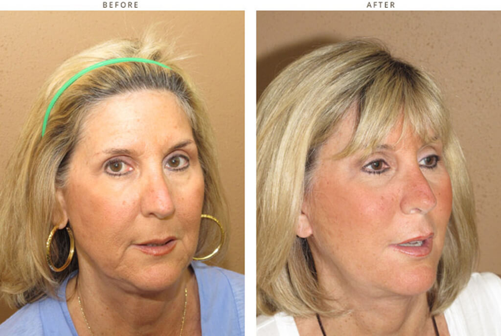 Complex Facial Rejuvenation Chicago - Before & After Pictures - Dr Gregory Turowski