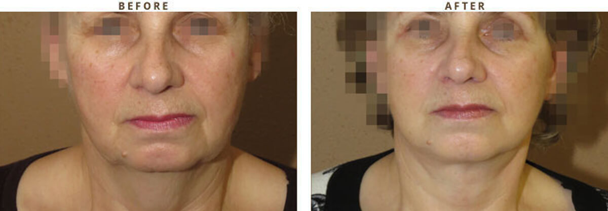 Facelift Chicago - Before & After Pictures - Dr Gregory Turowski