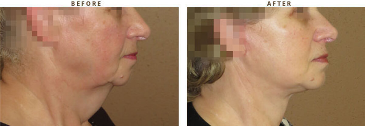 Facelift Chicago - Before & After Pictures - Dr Gregory Turowski