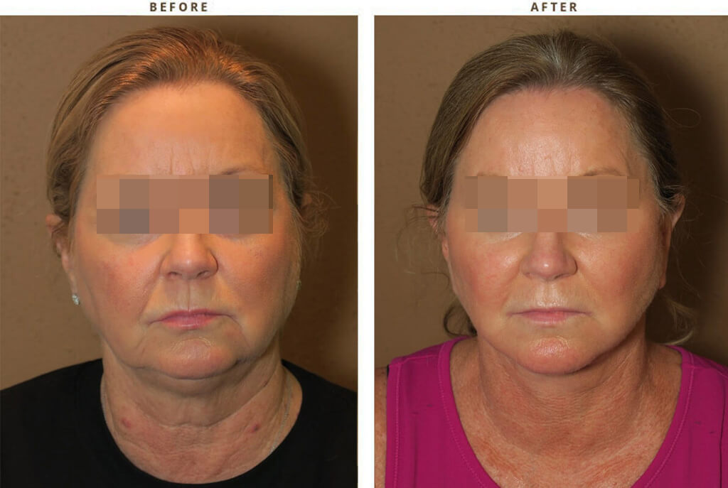 Complex Facial Rejuvenation Chicago - Before & After Pictures - Dr Gregory Turowski