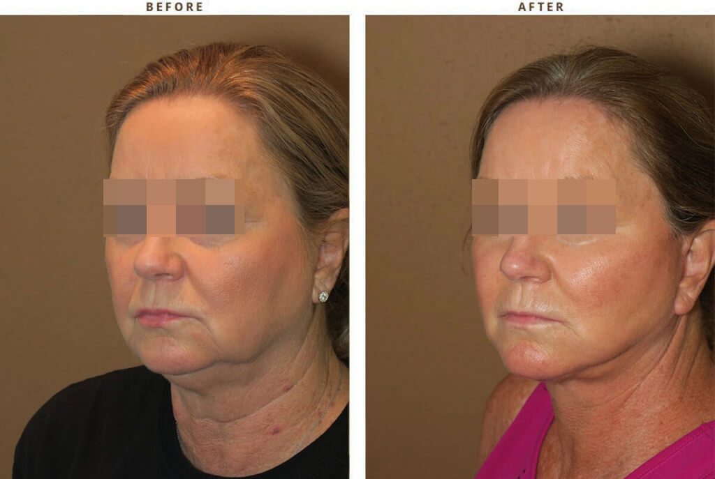 Complex Facial Rejuvenation Chicago - Before & After Pictures - Dr Gregory Turowski