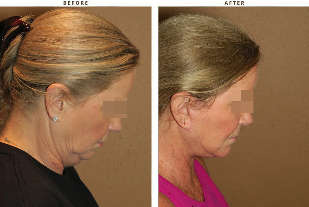 Complex Facial Rejuvenation Chicago - Before & After Pictures - Dr Gregory Turowski