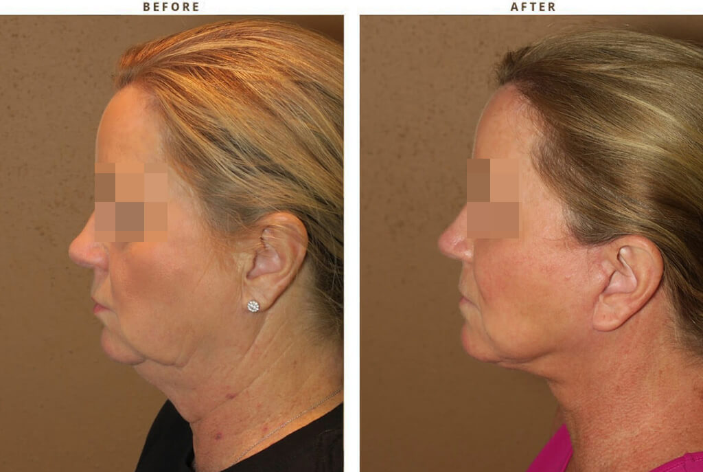 Complex Facial Rejuvenation Chicago - Before & After Pictures - Dr Gregory Turowski