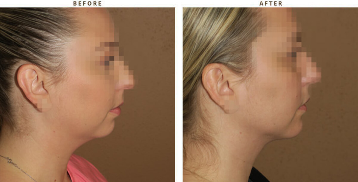 Chin Augmentation Chicago - Before & After Pictures - Dr Gregory Turowski