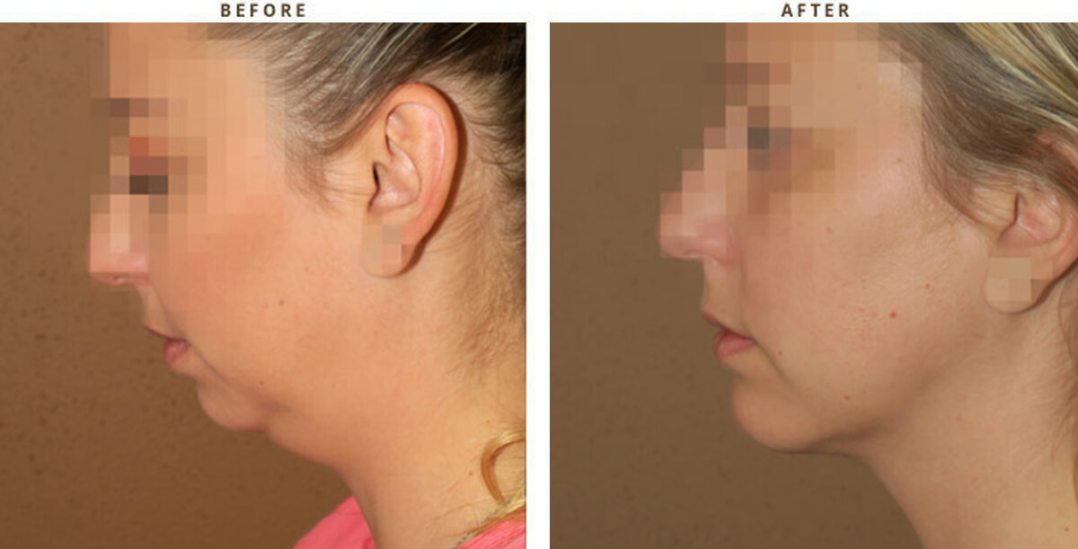 Chin Augmentation Chicago - Before & After Pictures - Dr Gregory Turowski