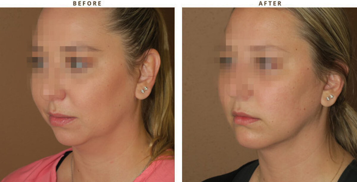 Chin Augmentation Chicago - Before & After Pictures - Dr Gregory Turowski