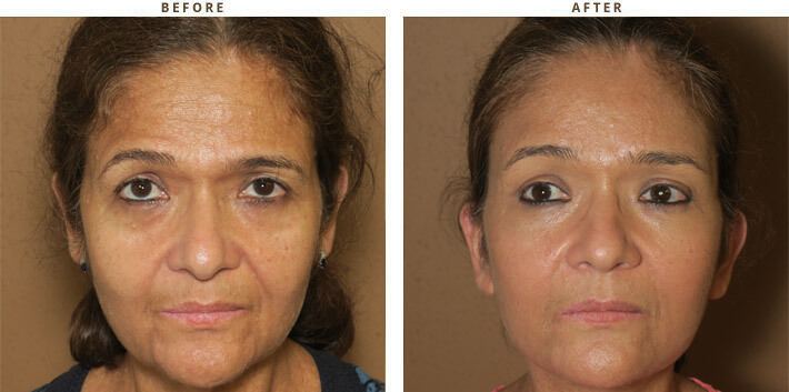 Complex Facial Rejuvenation Chicago - Before & After Pictures - Dr Gregory Turowski