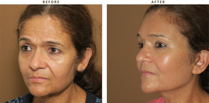 Complex Facial Rejuvenation Chicago - Before & After Pictures - Dr Gregory Turowski