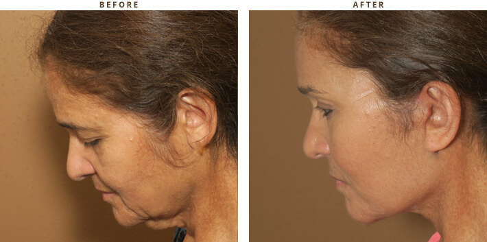 Complex Facial Rejuvenation Chicago - Before & After Pictures - Dr Gregory Turowski