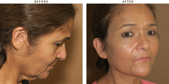 Complex Facial Rejuvenation Chicago - Before & After Pictures - Dr Gregory Turowski