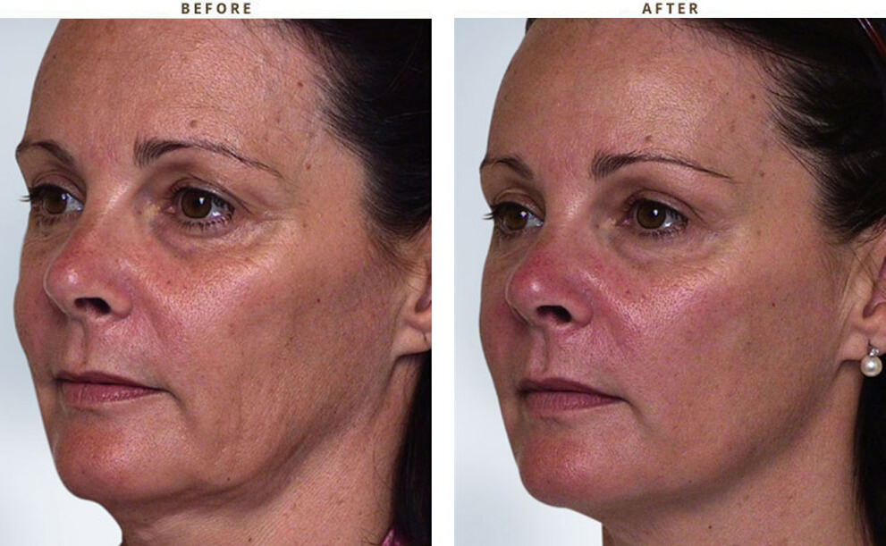 Non invasive Chicago - Before & After Pictures - Dr Gregory Turowski