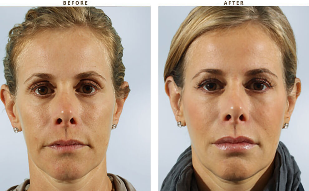 Non invasive Chicago - Before & After Pictures - Dr Gregory Turowski