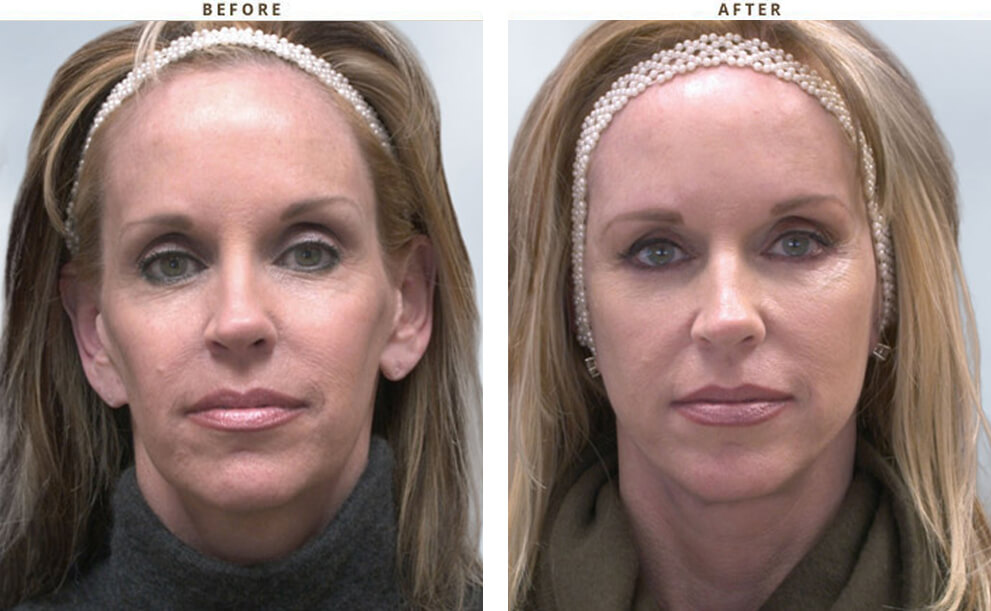 Non invasive Chicago - Before & After Pictures - Dr Gregory Turowski