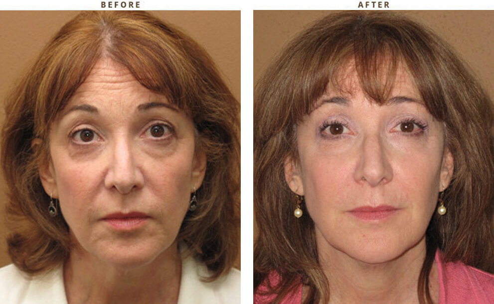 Non invasive Chicago - Before & After Pictures - Dr Gregory Turowski